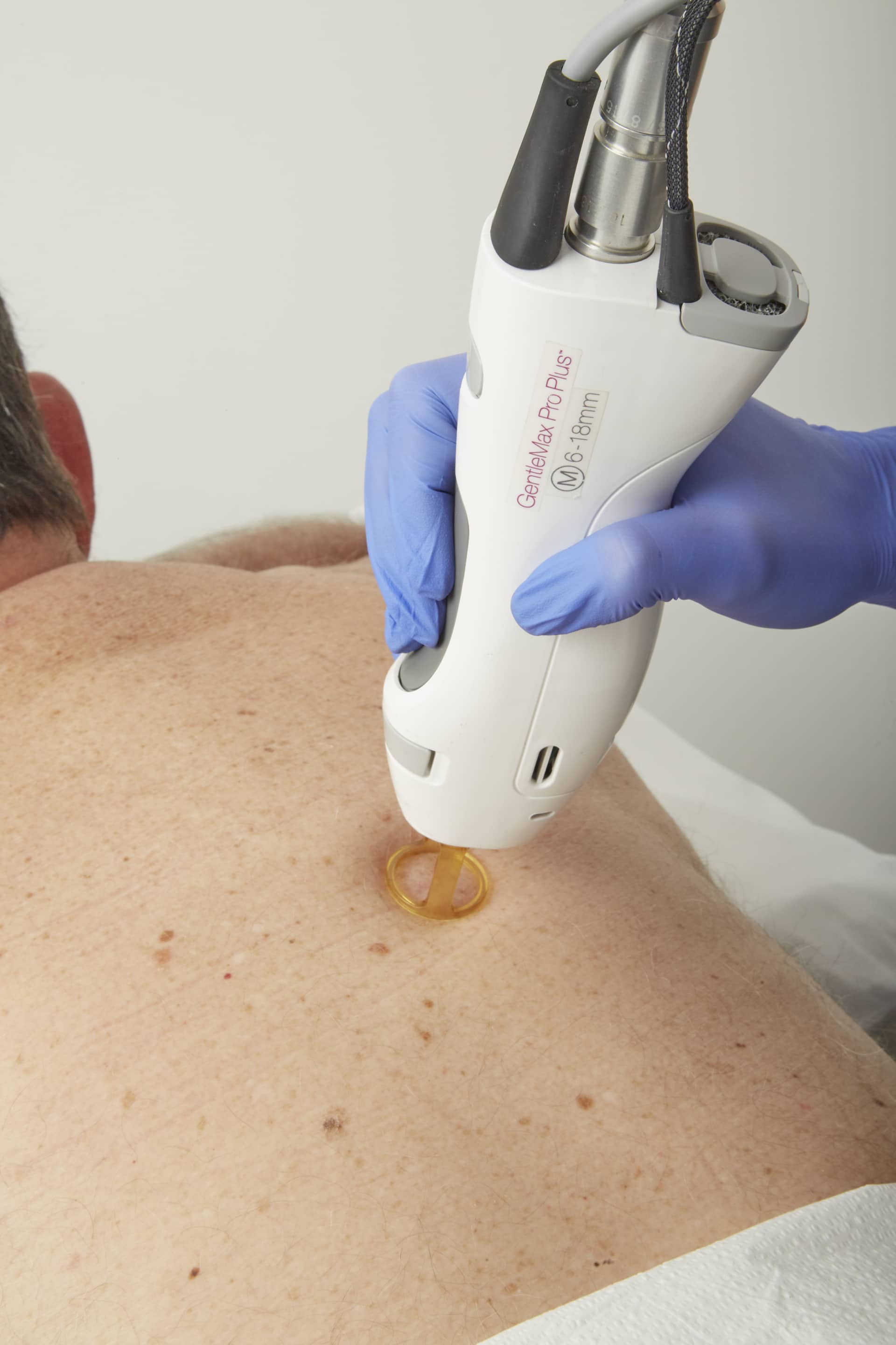 racine-carree-epilation-laser