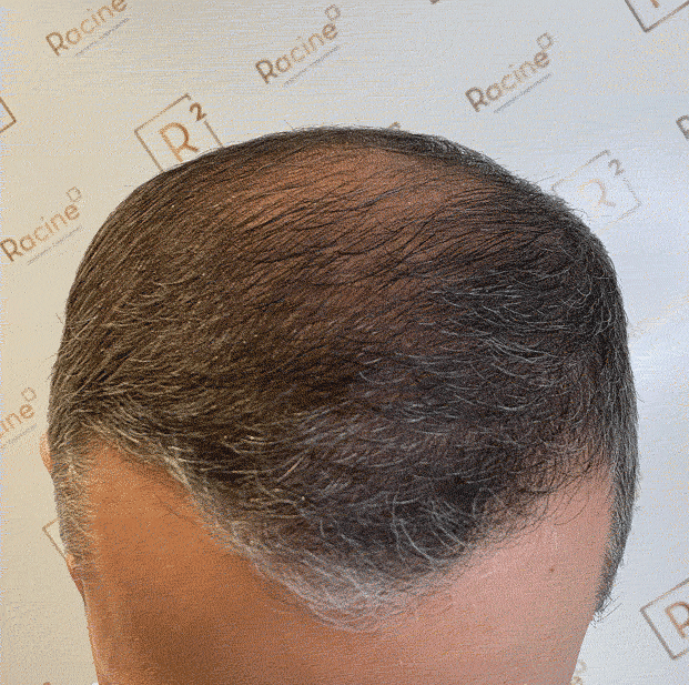 racine-carree-trichopigmentation-gif-1