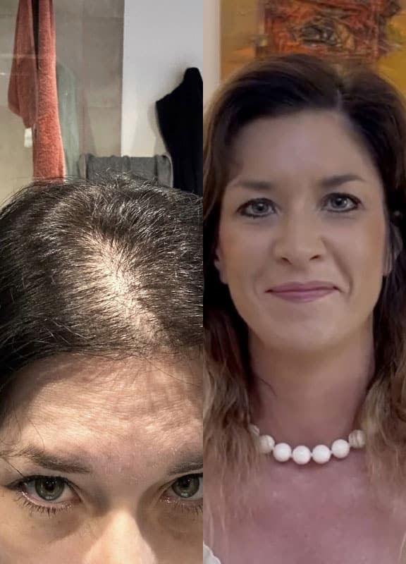 racine-carree-greffe-cheveux-elodie-38-ans-9-mois-vue2-2