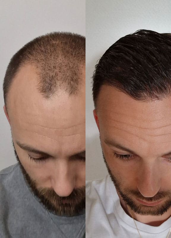 avant apres une greffe de cheveux de la ligne frontale