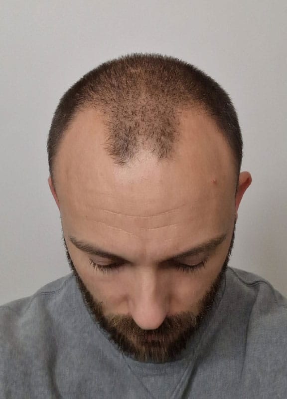 Un homme avec des cheveux clairsemés