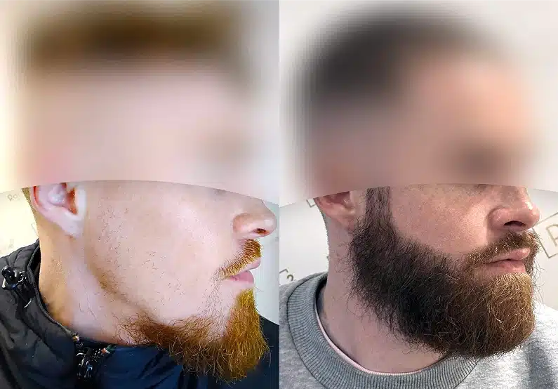 résultat avant après d'une greffe de barbe d'un jeune patient d'une trentaine d'année