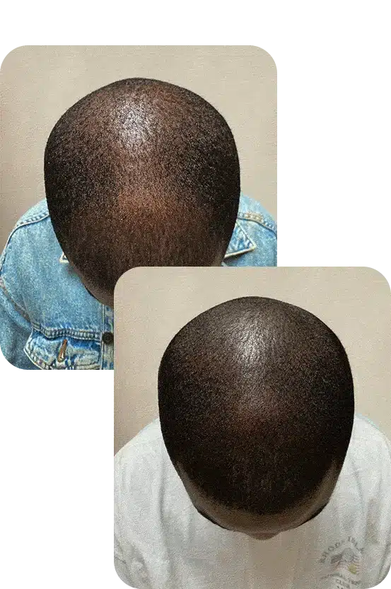 photo d'un avant après avec tricopigmentation réalisée à Racine² Paris