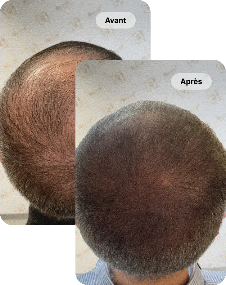 résultat avant et après d'une tricopigmentation réalisée au centre Racine² à Paris
