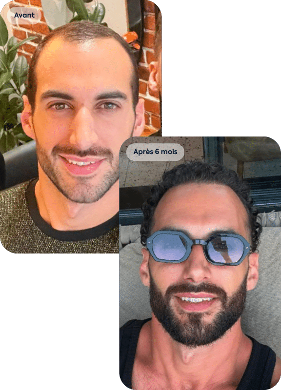 racine-carree-greffe-cheveux-anthony-33-ans-6-mois-1