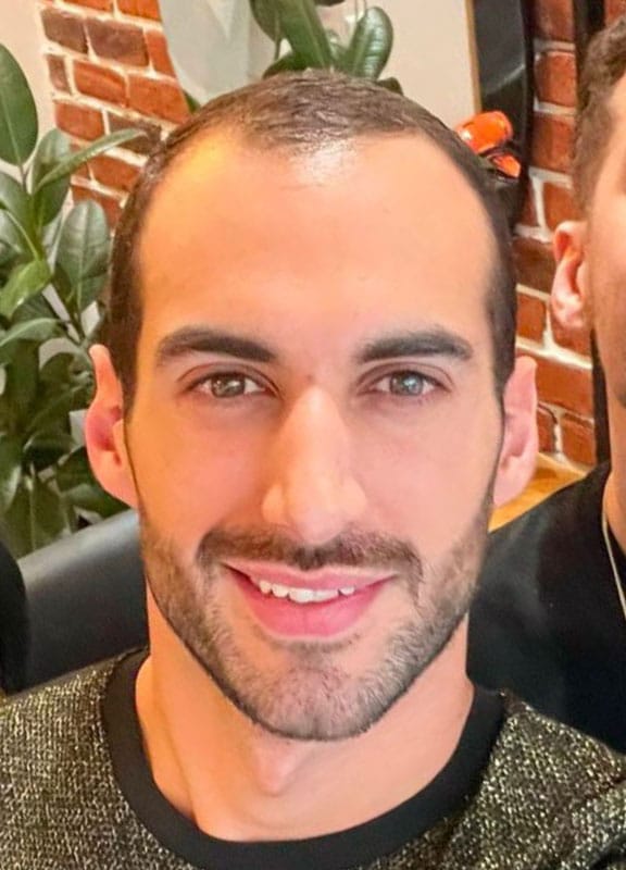racine-carree-greffe-cheveux-anthony-33-ans-avant