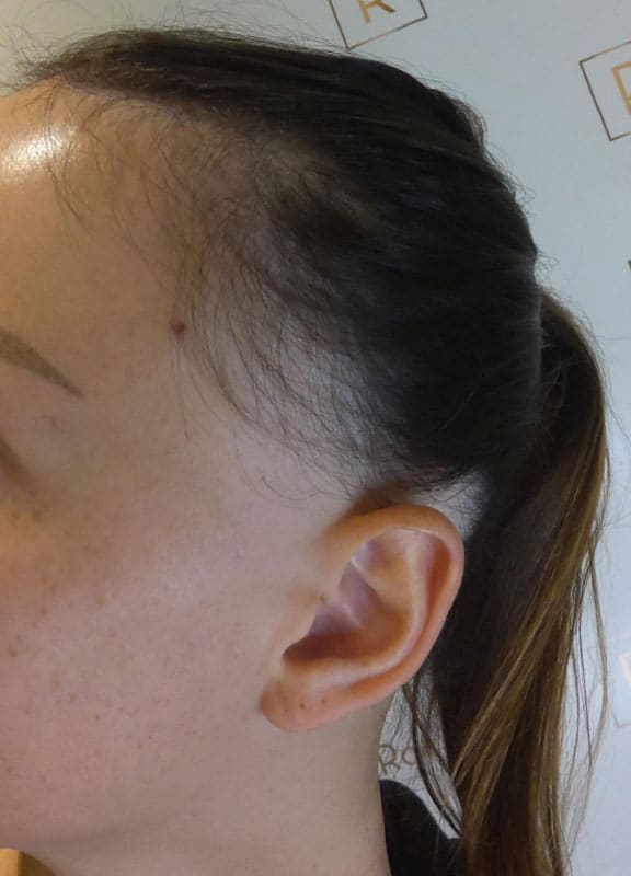 racine-carree-greffe-cheveux-femme-24-ans-avant