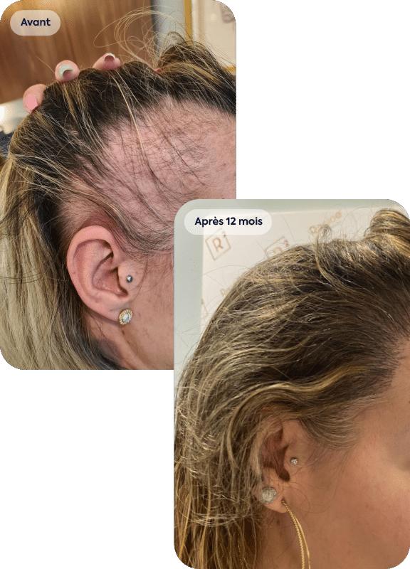avant après d'une greffe de cheveux chez une femme avec alopécie de traction