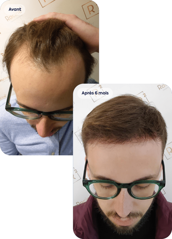Greffe de cheveux avant après sur calvitie précoce d'un homme de 25 ans