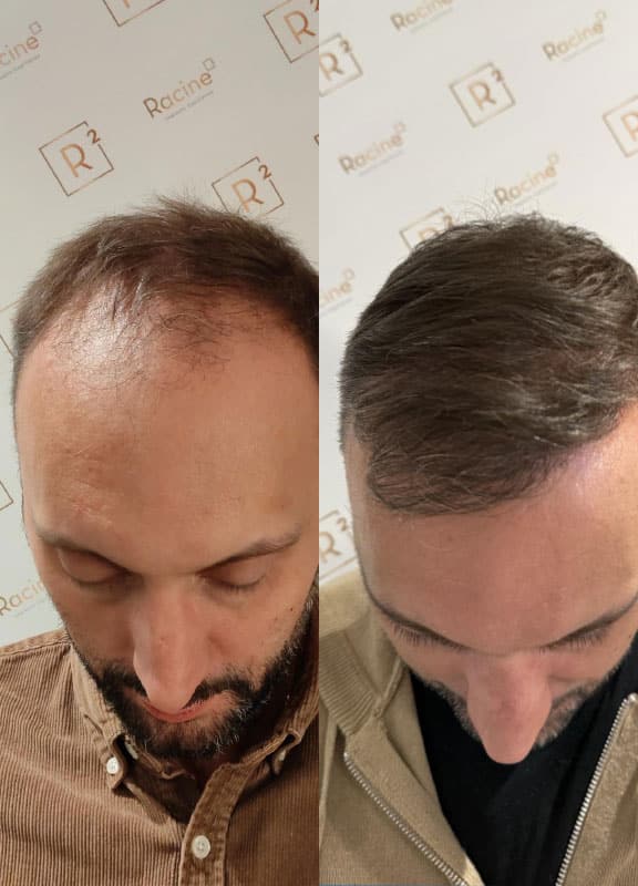 racine-carree-greffe-cheveux-Homme-44-ans-12-mois-2