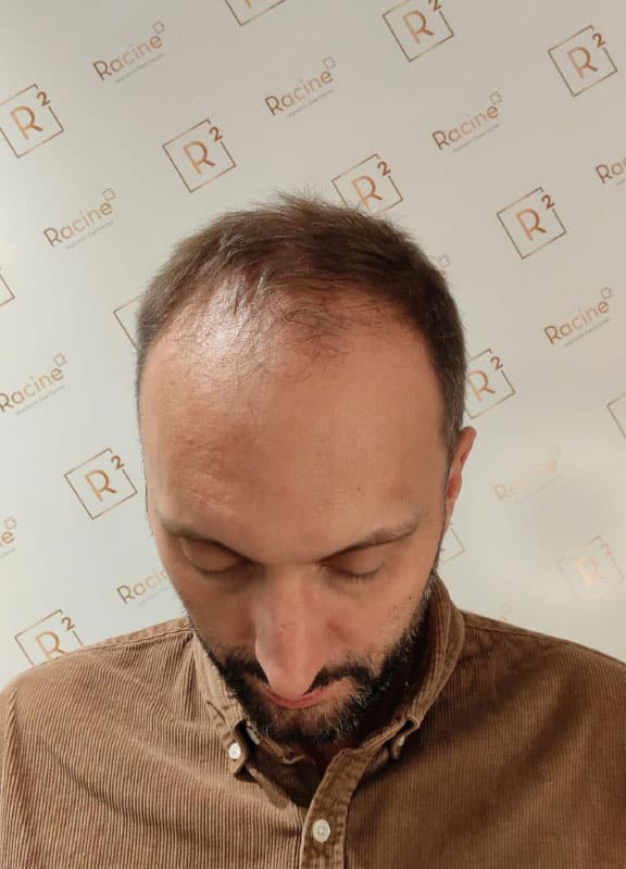 racine-carree-greffe-cheveux-Homme-44-ans-avant