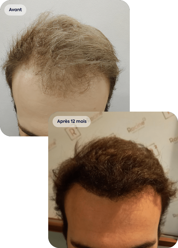 greffe de cheveux d'une ligne frontale