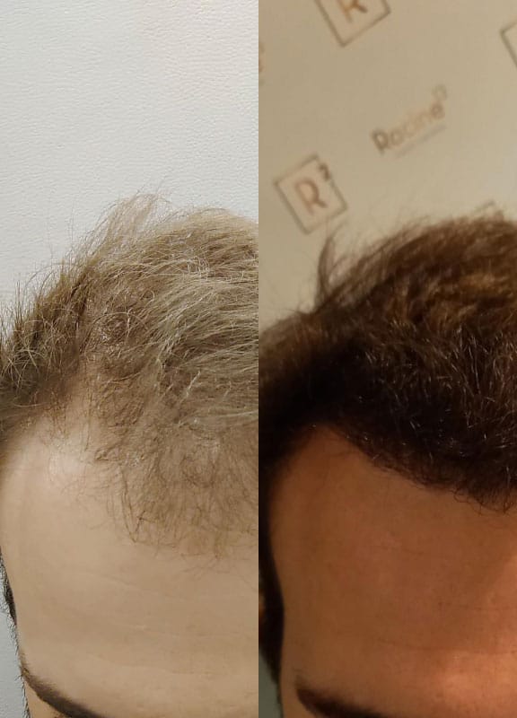 avant apres une greffe de cheveux choi