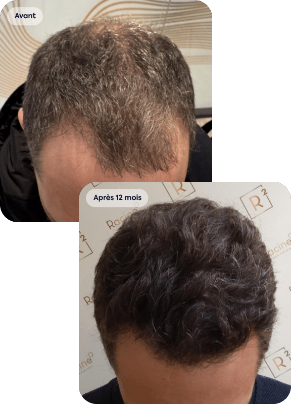 avant apres d'une greffe de cheveux sur les golfes et le vertex