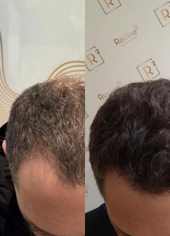 Résultat d'une greffe de cheveux FUE avec lame Saphir