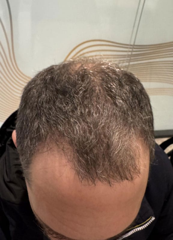 un homme vu du dessus avec une calvitie