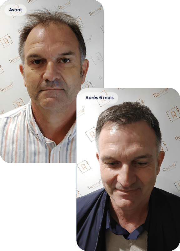 un avant après greffe de cheveux d'un homme de 55 ans
