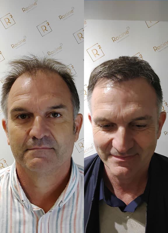 Resultat avant apres d'une greffe de cheveux sur une alopécie quasi totale