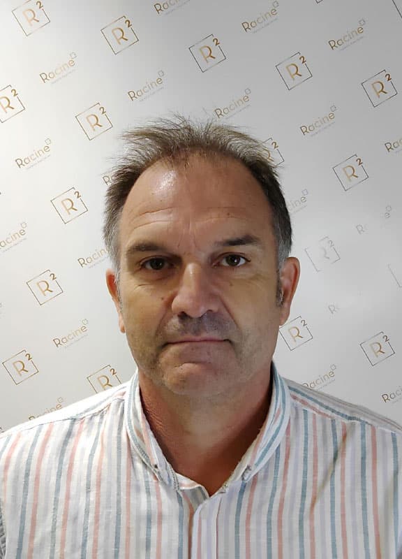 racine-carree-greffe-cheveux-lfp-laurent-55-ans-avant