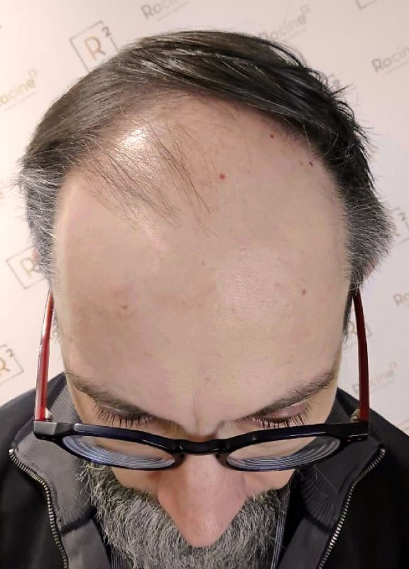 racine-carree-greffe-cheveux-olivier-48-ans-12-mois-avant