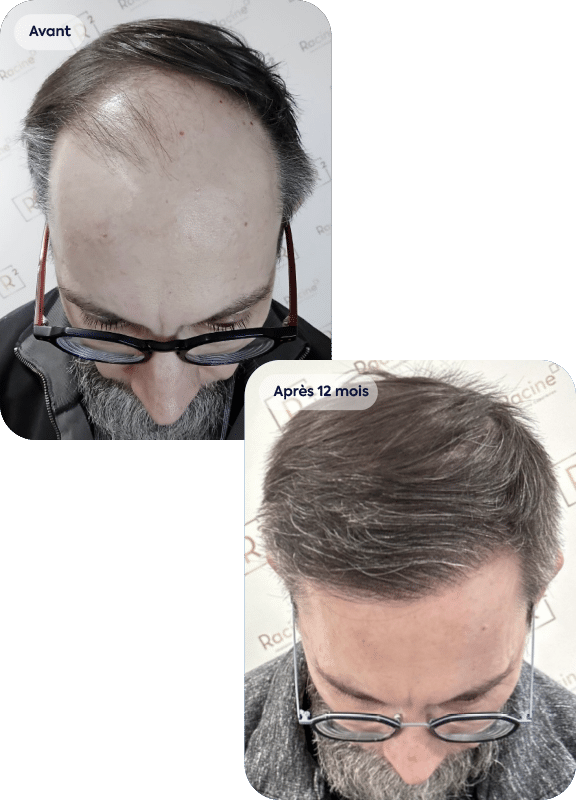 greffe de cheveux gris avant après
