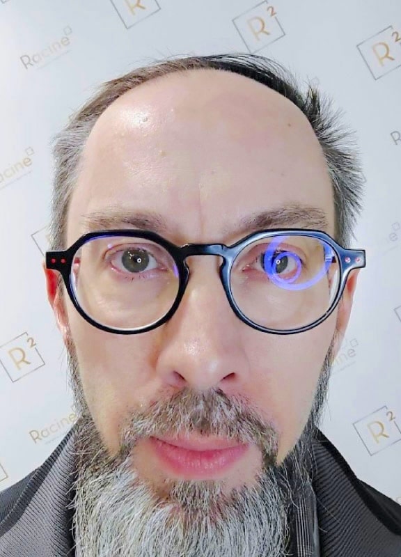 racine-carree-greffe-cheveux-olivier-48-ans-vue1-avant