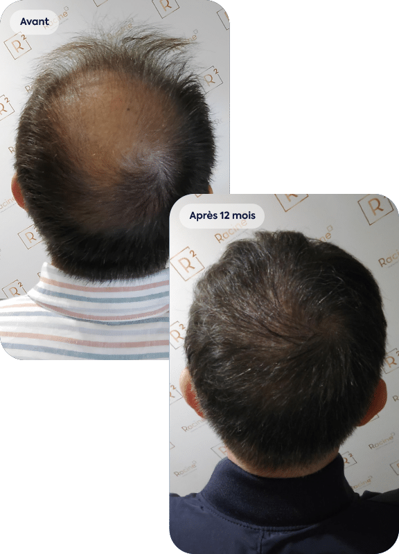 Résultat avant après d'une greffe de cheveux FUE réalisée a Racine Carrée