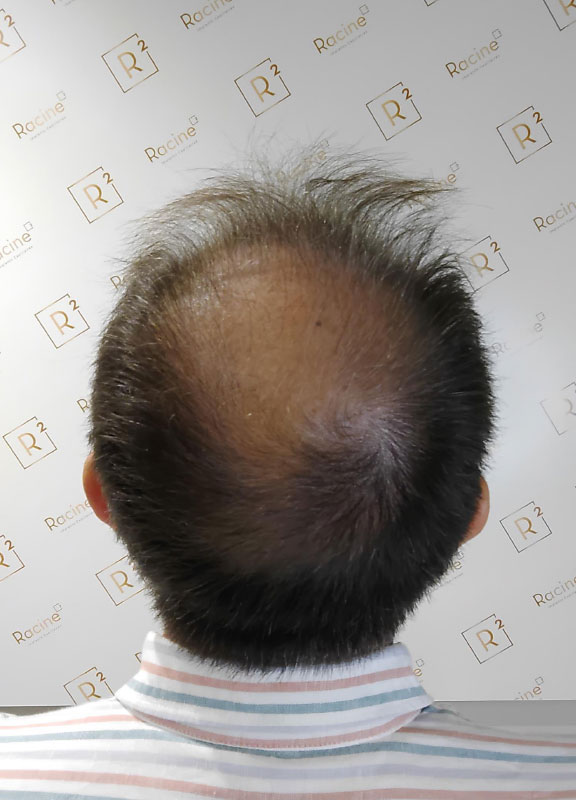 racine-carree-greffe-cheveux-vertex-laurent-55-ans-avant