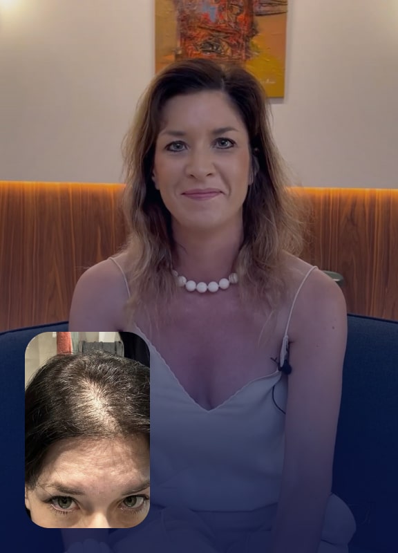 racine-carree-interview-greffe-cheveux-elodie