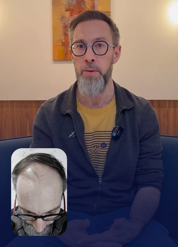 racine-carree-interview-greffe-cheveux-olivier