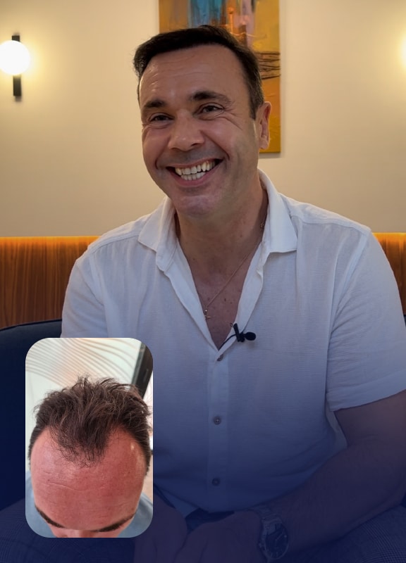 racine-carree-interview-greffe-cheveux-sebastien