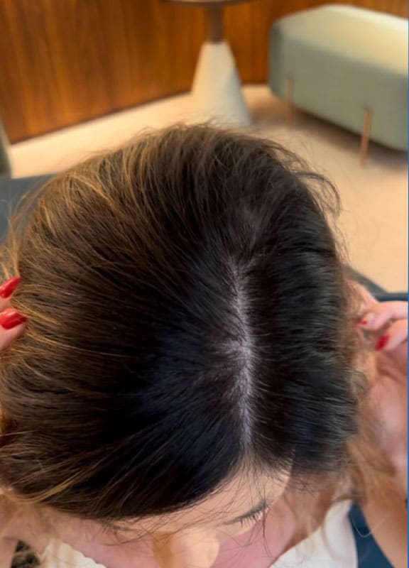 racine-carree-greffe-cheveux-elodie-apres