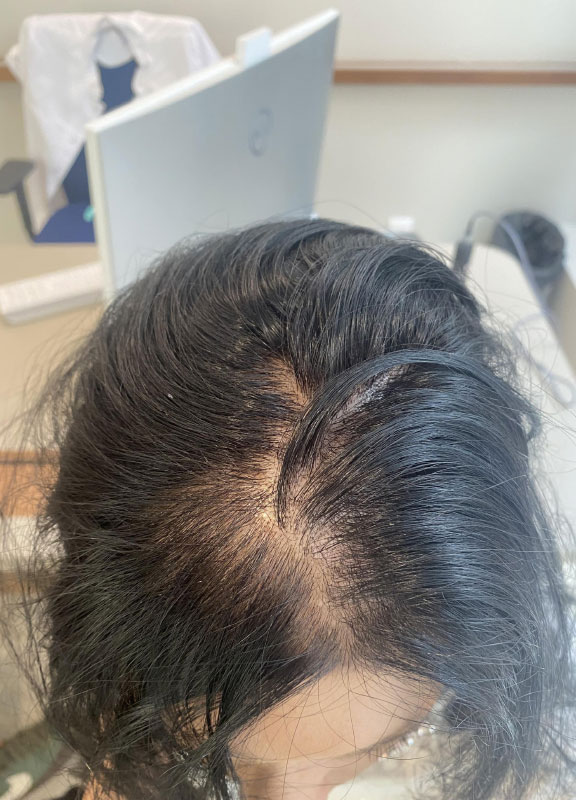 racine-carree-greffe-cheveux-elodie-avant