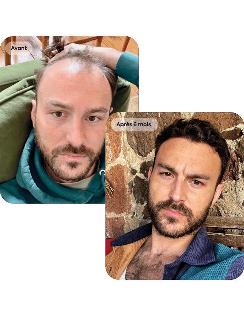 R2-patient-2-avant-apres-640-830