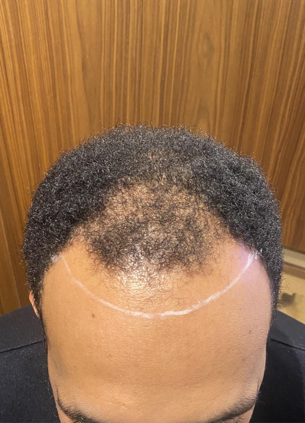 r2-reference-patient-cheveux-afro-1-avant