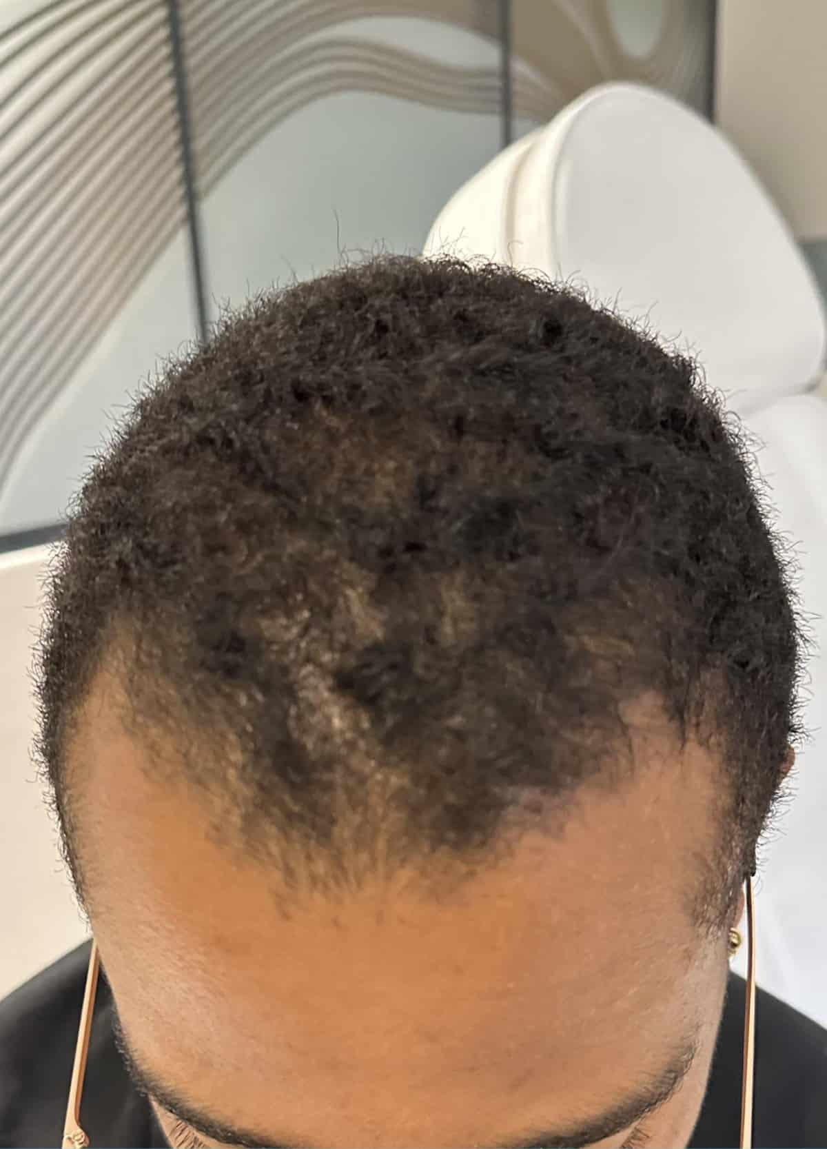 r2-reference-patient-cheveux-afro-2-avant