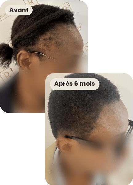 Résultat d'une greffe de cheveux sur une alopécie de traction